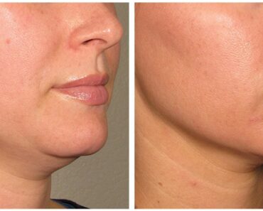 001-before_after_ultherapy_results_under-chin18