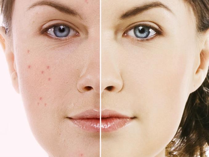How to Cure Acne Naturally? 5 Simple Homemade Acne Remedies